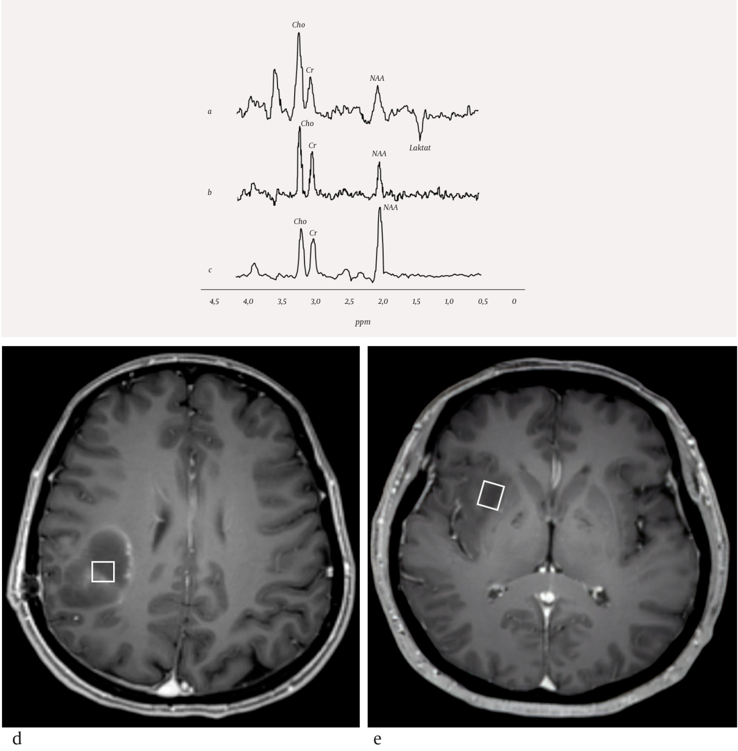 Figur 2 MR-spektre av a) h&oslash;ygradig gliom, b) lavgradig gliom og c) frisk person samt T1-vektede MR-bilder med lokalisering&hellip;