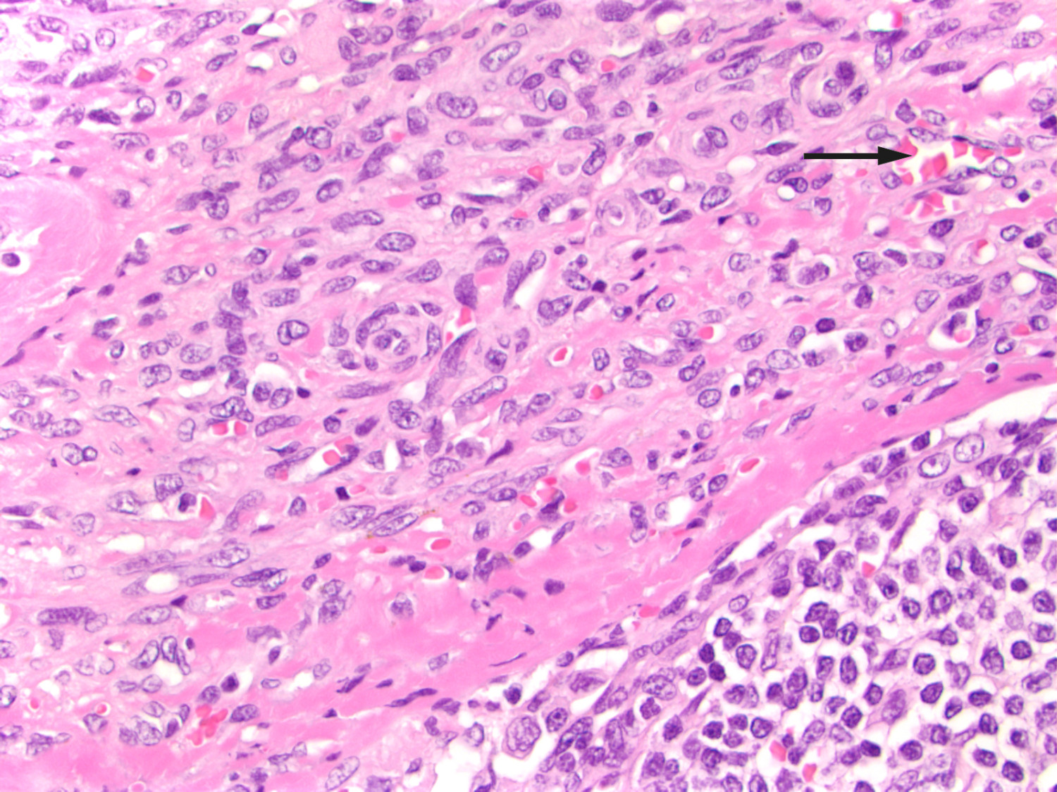 Figur 3 Lymfeknute med kapill&aelig;r proliferasjon. Spoleformede celler og ekstravaserte erytrocytter i kapselen (pil). Normal&hellip;