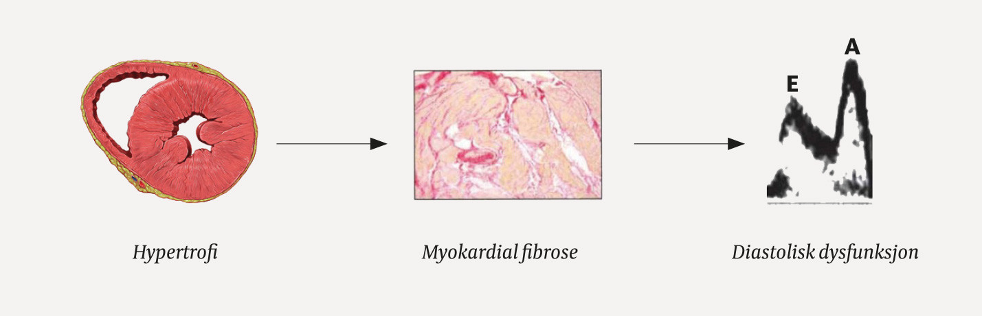 Figur 1 Fra hypertensjon til diastolisk dysfunksjon: Prinsippfigur som til venstre viser hypertrofi (CC BY 2.5), i midten&hellip;