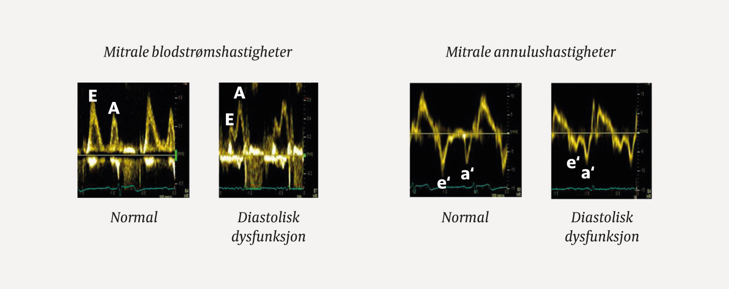 Figur 3 Diastolisk funksjon ved dopplerekkokardiografi: Mitral blodstr&oslash;mshastighet er ventrikkelens fylningshastighet&hellip;