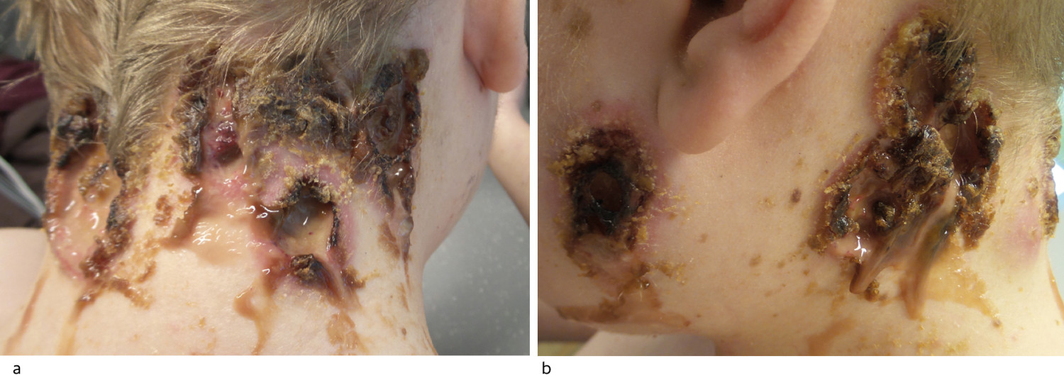 Figur 1 Ulcerasjoner i nakken (a) og preaurikul&aelig;rt (b) ved innkomst. Det var rikelig med purulent sekresjon. S&aring;rkanter og&hellip;