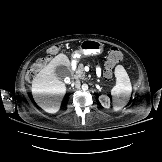 Figur 2 CT abdomen viser distendert gallebl&aelig;re med markert veggtykkelse, omkringliggende fokal fettvevsreaksjon samt&hellip;
