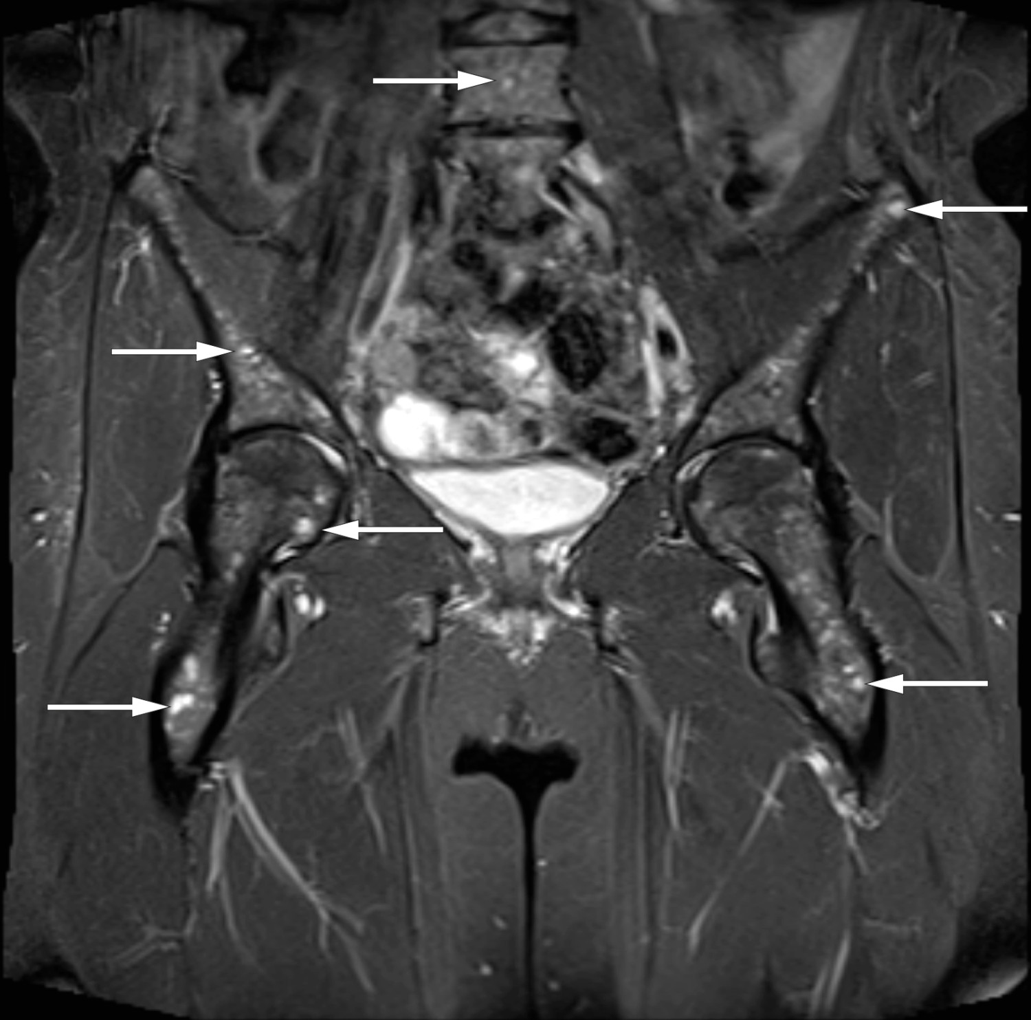 Figur 1 Koronalt, fettsupprimert, T2-vektet MR-bilde med sm&aring;flekkede, diffust utbredte signalavvik i beinmarg (piler), mest&hellip;