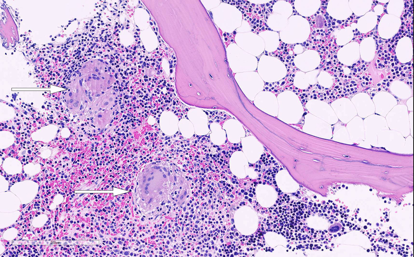Figur 2 Histologisk bilde fra beinmarg, som viser to velformede, ikke-nekrotiserende granulomer (piler) (hematoksylin- og&hellip;