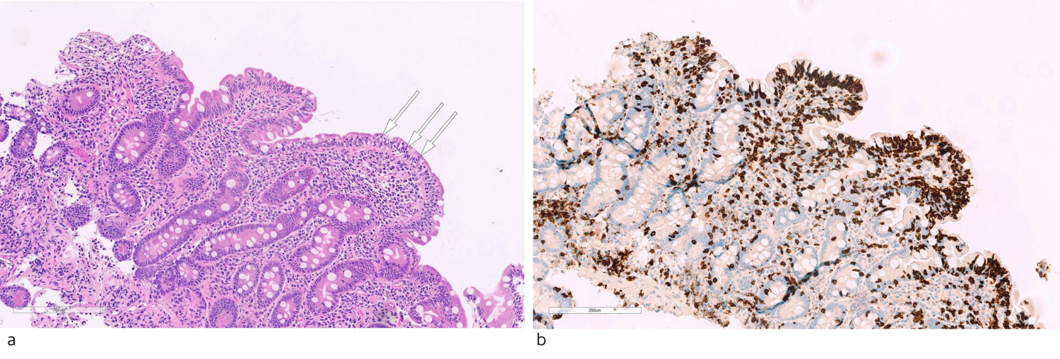 Figur 3 Histologisk bilde fra duodenalslimhinne. a) Duodenalslimhinnebiopsier viste lave, brede totter (subtotal totteatrofi&hellip;