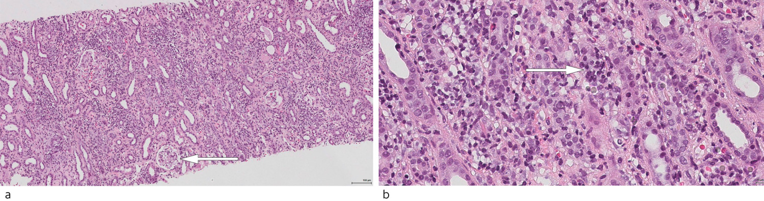 Figur 1 a) Histologisk snitt av n&aring;lebiopsi fra nyre farget med hematoksylin-eosin (HE), 100 x forst&oslash;rrelse. Bildet viser&hellip;