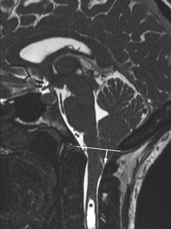 Figur 1 Et typisk radiologisk funn ved Chiari-malformasjon type 1 p&aring; MR-bilde i sagittalplan (ciss-sekvens). Her ses kaudal&hellip;