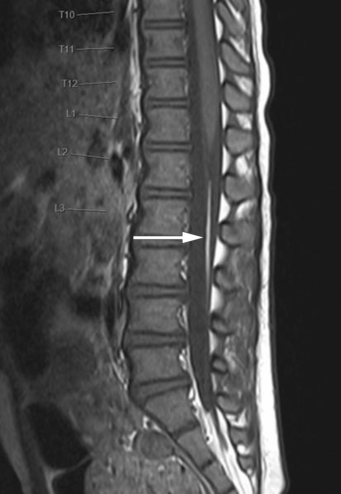 Figur 2 Fibrolipom av filum terminale (pil) p&aring; sagittalt T1-vektet MR-bilde. Radiologisk sett er det strengt tatt ingen&hellip;