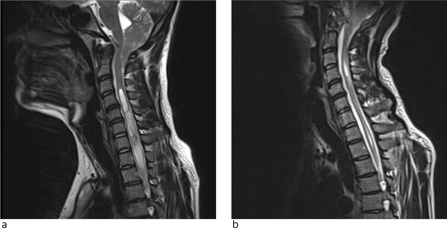 Figur 3 Eksempel p&aring; tydelig tilbakegang av syringomyeli (a) ca. fem &aring;r etter dekompresjon av foramen magnum (b) i sagittalt&hellip;