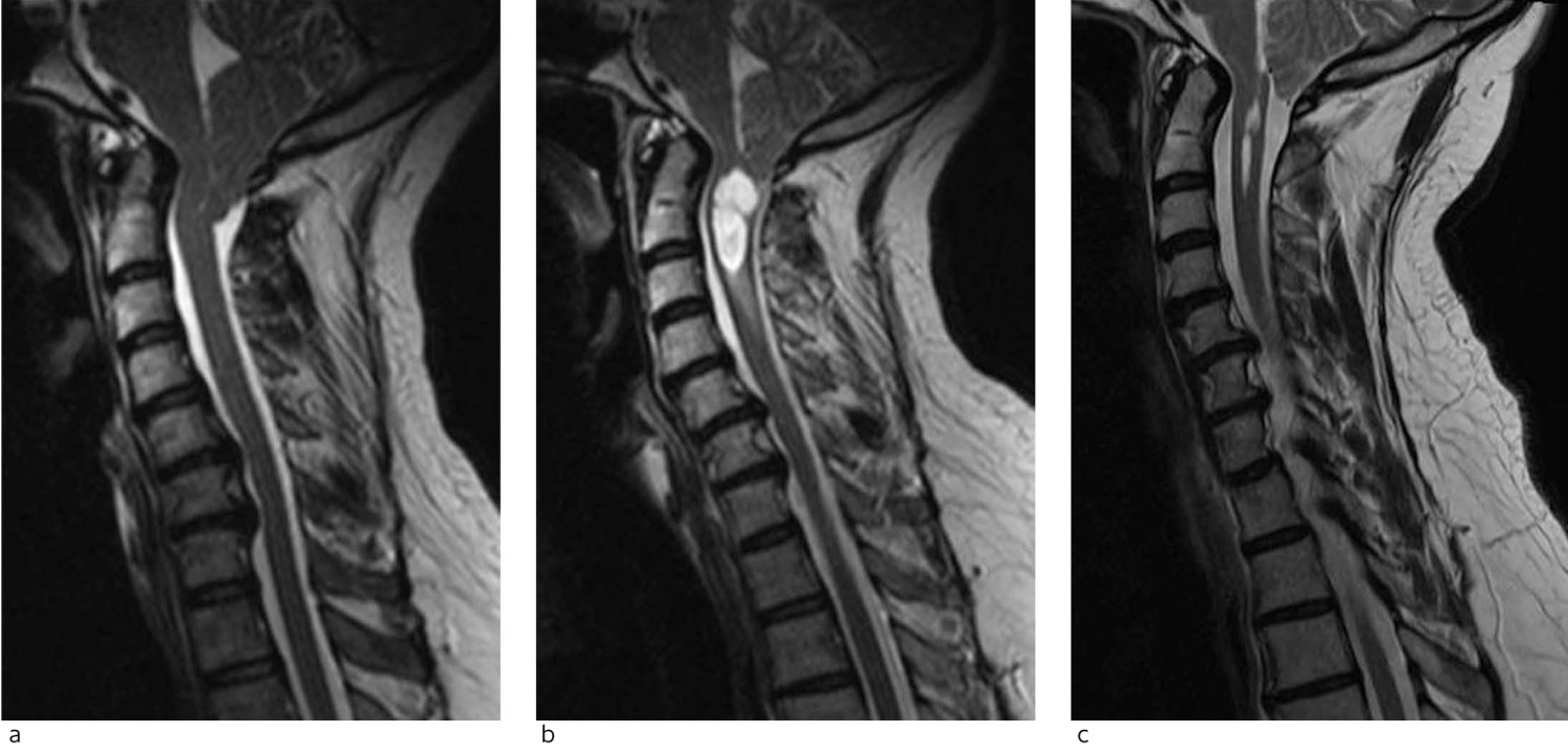 Figur 4 Et eksempel p&aring; en pasient med uttalt kaudal ektopi av lillehjernetonsiller og trange forhold i foramen magnum (a) i&hellip;