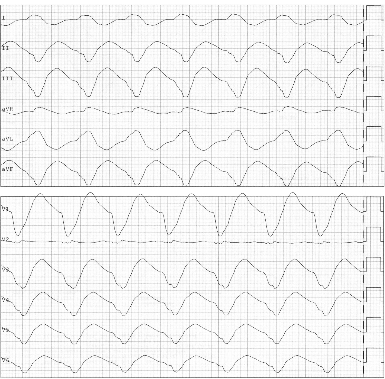 Figur 1 EKG fra dag 1 viser bredkomplekset rytme med QRS-bredde p&aring; over 380 ms og diffuse ST-T-forandringer. Frekvens 73&hellip;