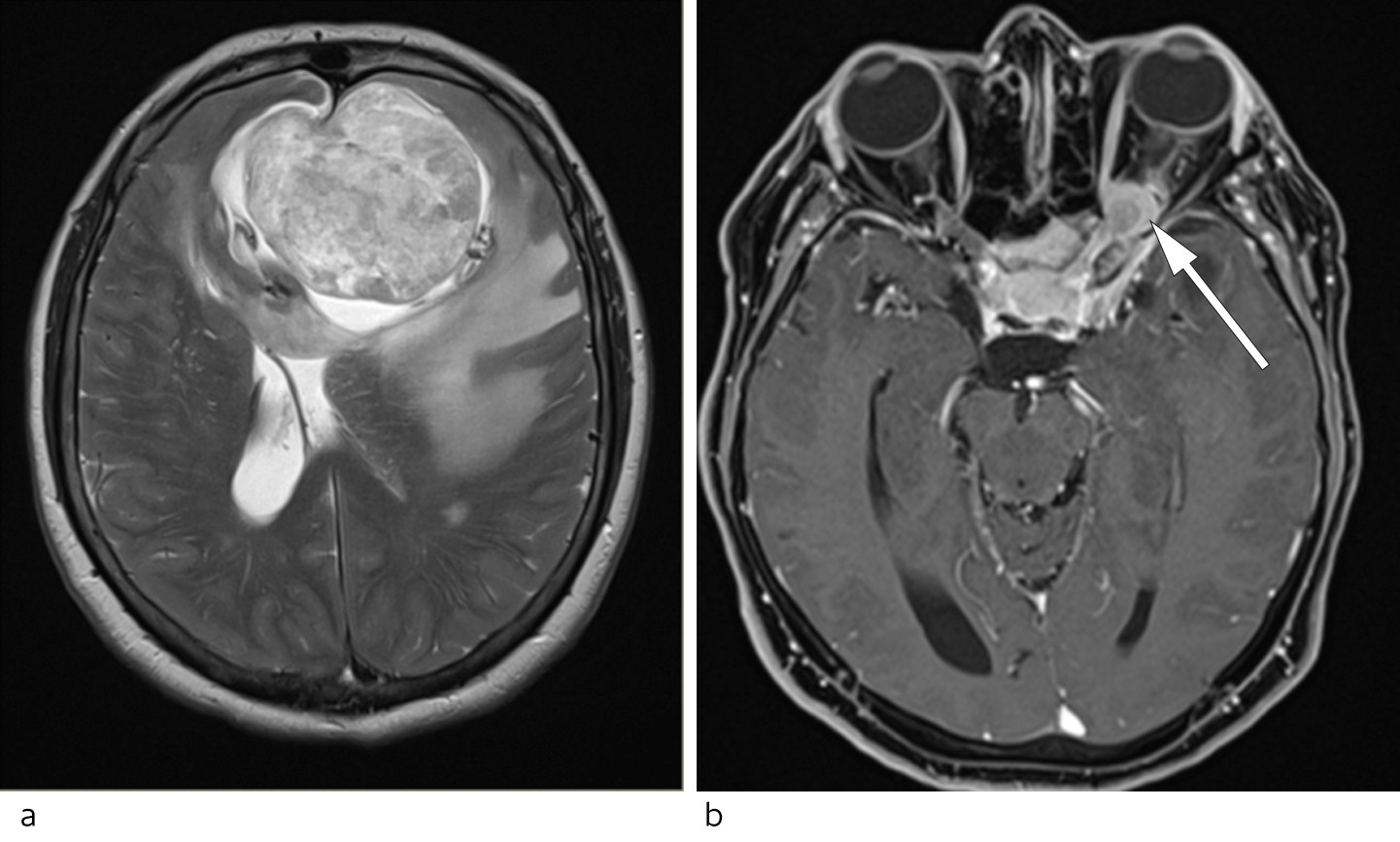 Figur 2 a) MR av hodet (aksial, T2-vektet sekvens) viser en stor, heterogen, ekstraaksial tumor i fremre skallegrop. Tumor&hellip;