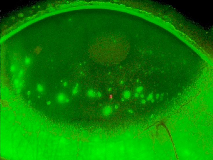 Figur 2 Farging med fluorescein, belysning med bl&aring;tt lys og gulfilter avdekker punktat fargeopptak (&laquo;staining&raquo;) av&hellip;