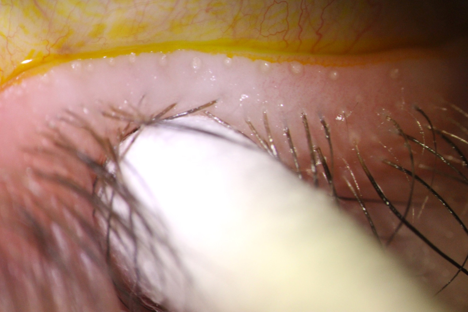 Figur 3 Vurdering av meibumkvalitet og t&oslash;mmingsgrad kan avdekke meibomsk kjerteldysfunksjon og utf&oslash;res ved &aring; ut&oslash;ve et lett&hellip;