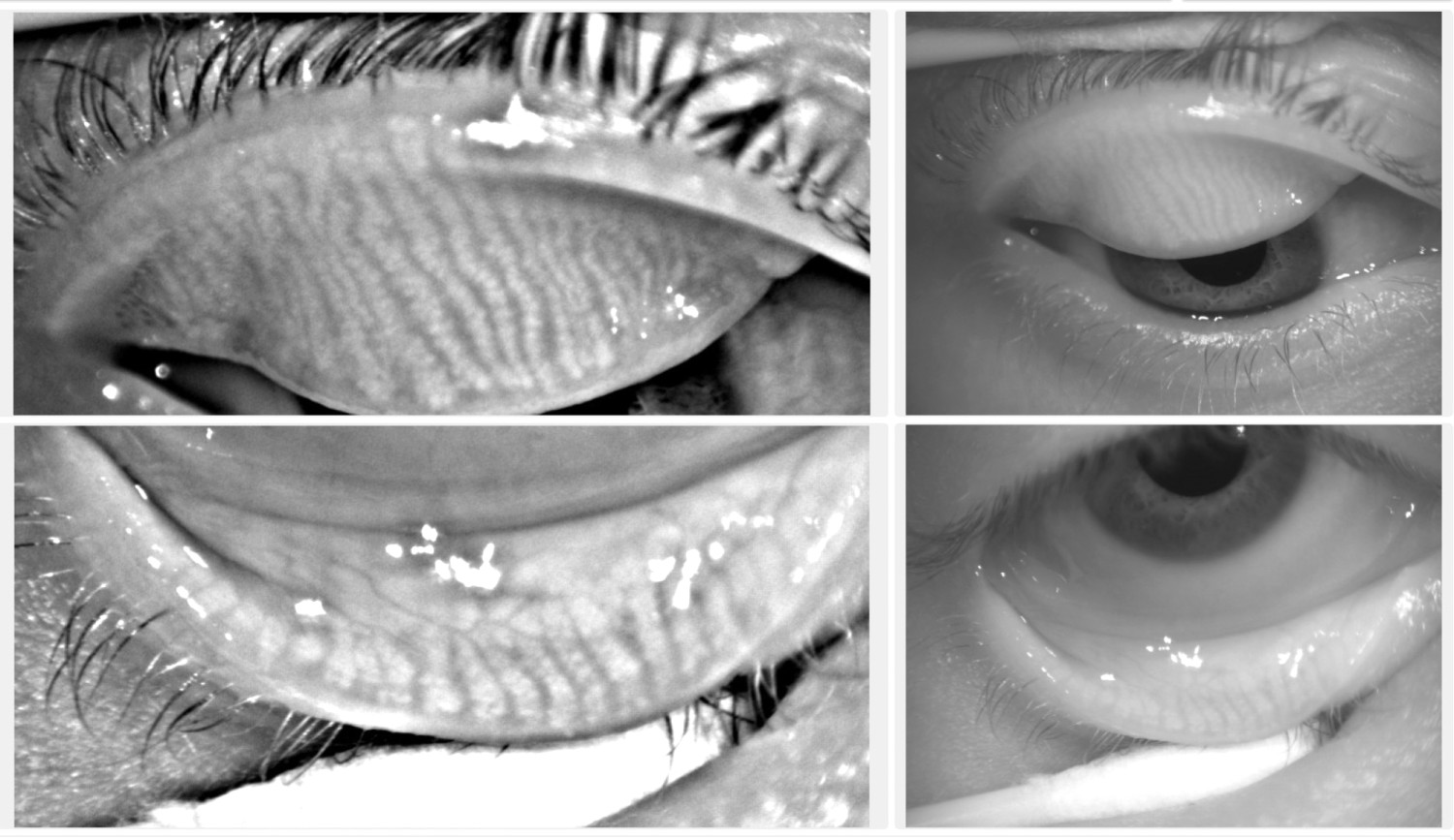 Figur 4 Meibografi fremstiller de meibomske kjertlene ved hjelp av infrar&oslash;d fotografering. Bildene viser normal&hellip;