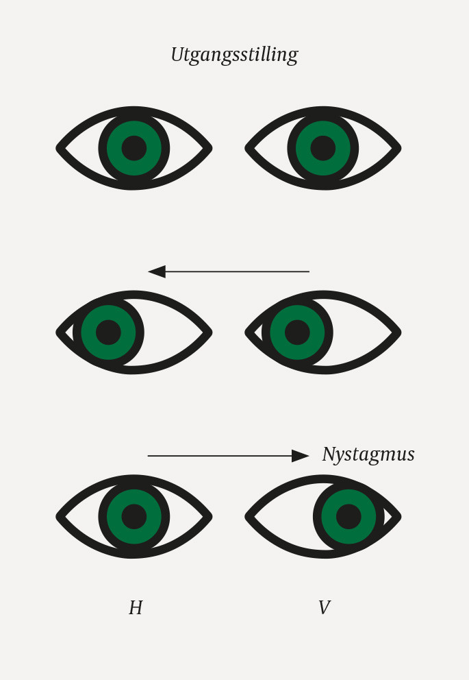 Figur 1 Internukle&aelig;r oftalmoplegi