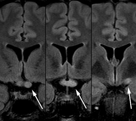 Figur 3 Koronal FLAIR-MR-serie med langstrakt lesjon i venstre nervus opticus, gjennom chiasma opticum og bakover i venstre&hellip;