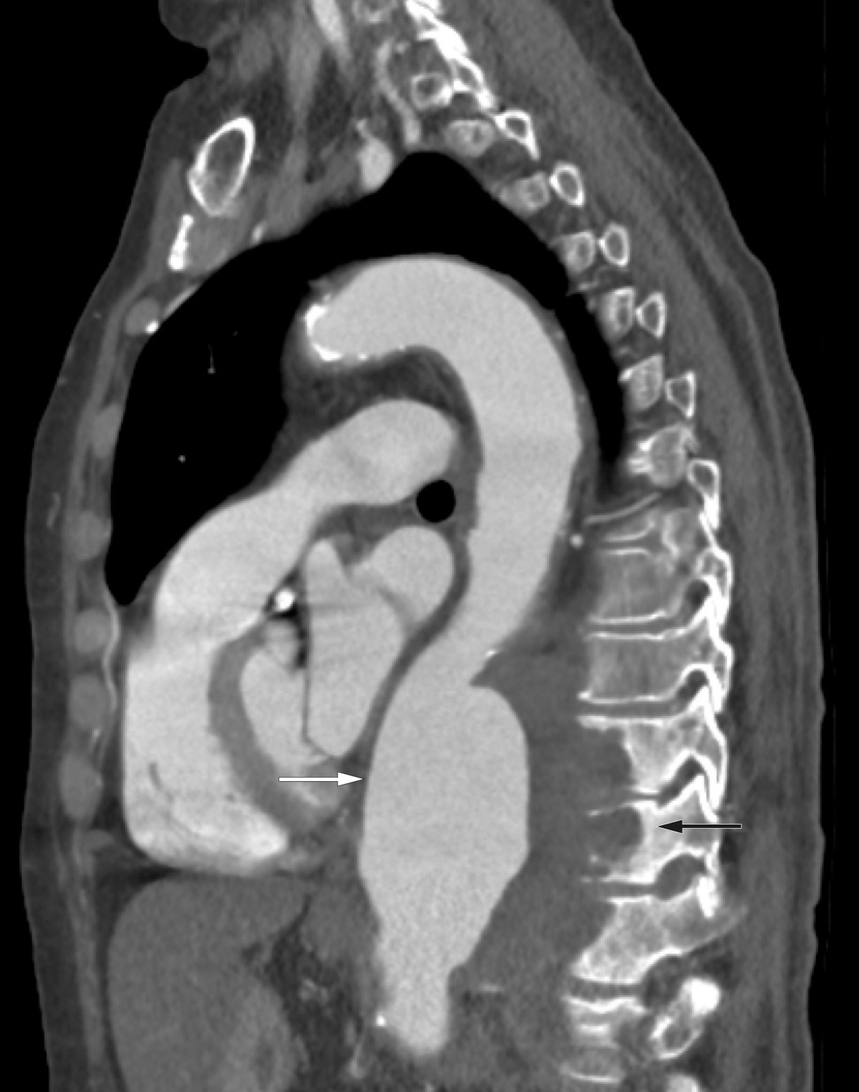 Figur 1 CT thorax med bl&oslash;tvevsvindu som viser aneurismet (hvit pil) og en paravertebral ansamling med osteodestruksjon i&hellip;