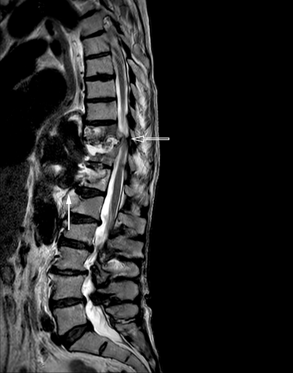 Figur 2 MR columna med T2-vektet sagittalsnitt viser abscessdanning (fylt pil) og en mindre epidural abscess (tom pil). I&hellip;