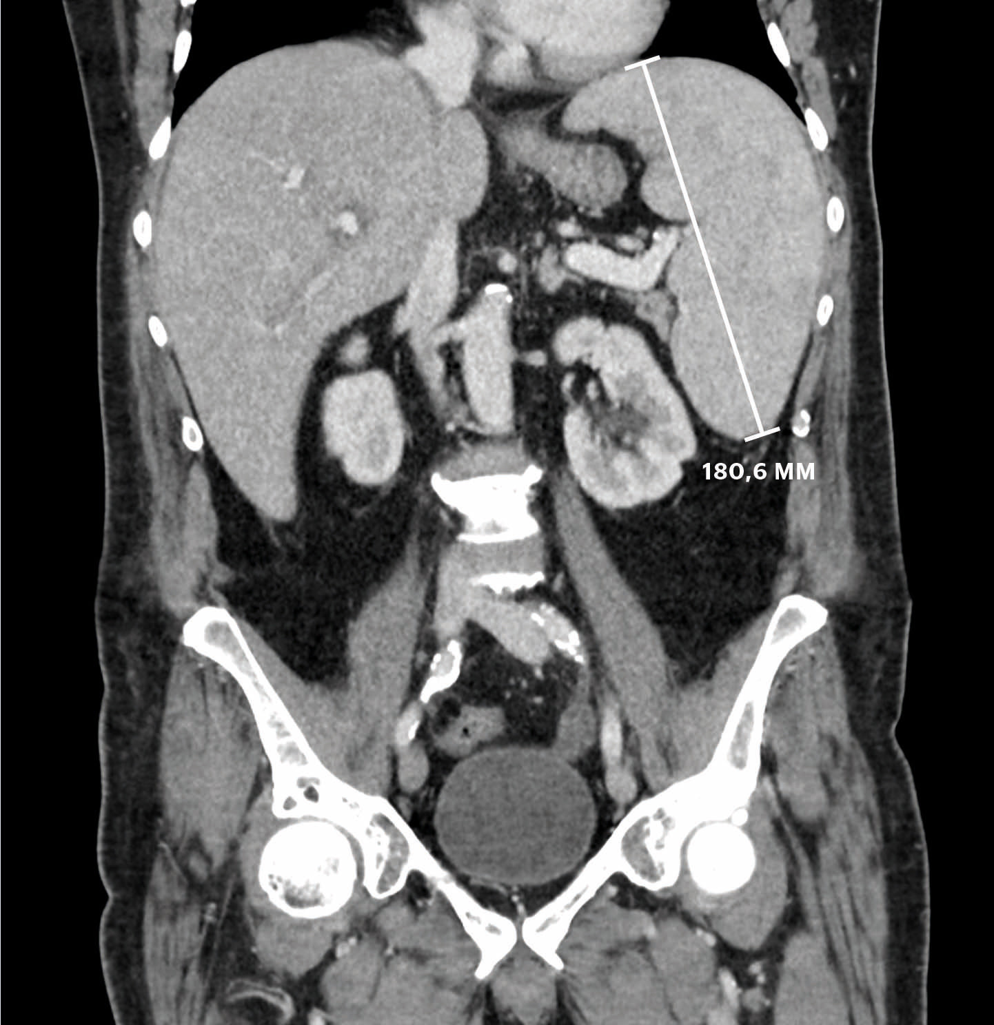 Figur 1 CT tatt dag 13 viste forst&oslash;rret milt (18 cm) og lever.