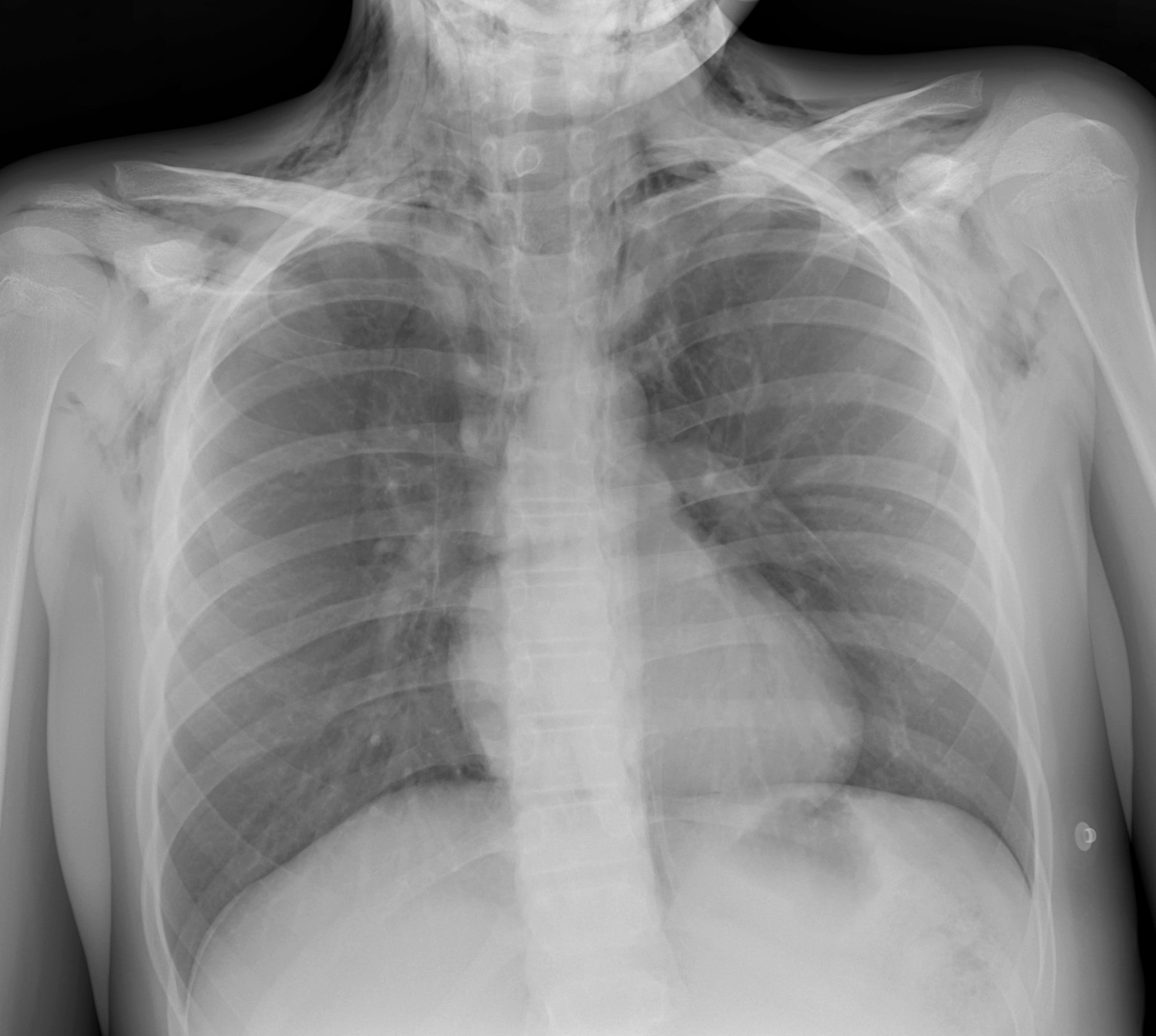 Figur 1 R&oslash;ntgen thorax viste pneumomediastinum og utbredt bl&oslash;tvevsemfysem over hals og &oslash;vre thorax og mulig pneumothorax.