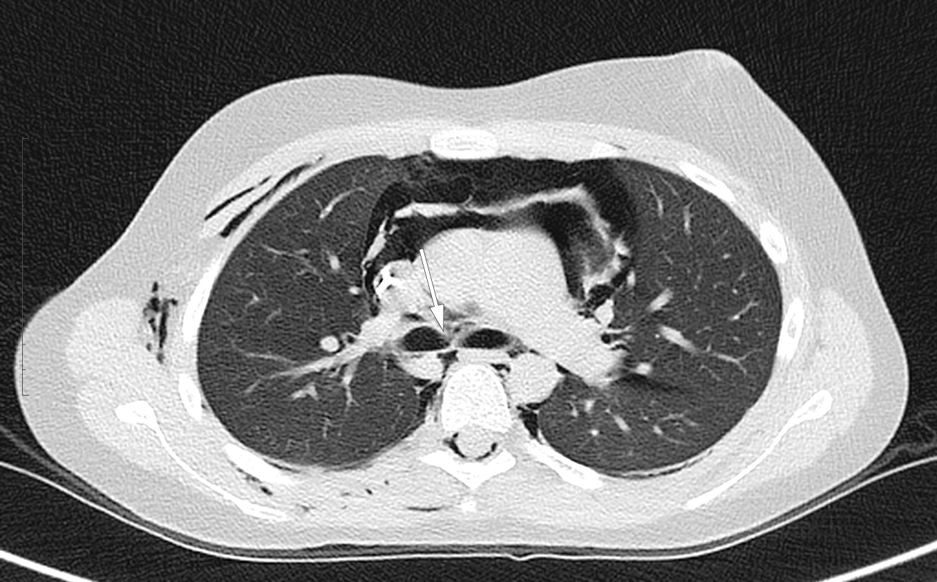 Figur 2 CT thorax lavdose uten kontrastmiddel, transversalsnitt i lungevindu viste pneumomediastinum og luft intraspinalt&hellip;