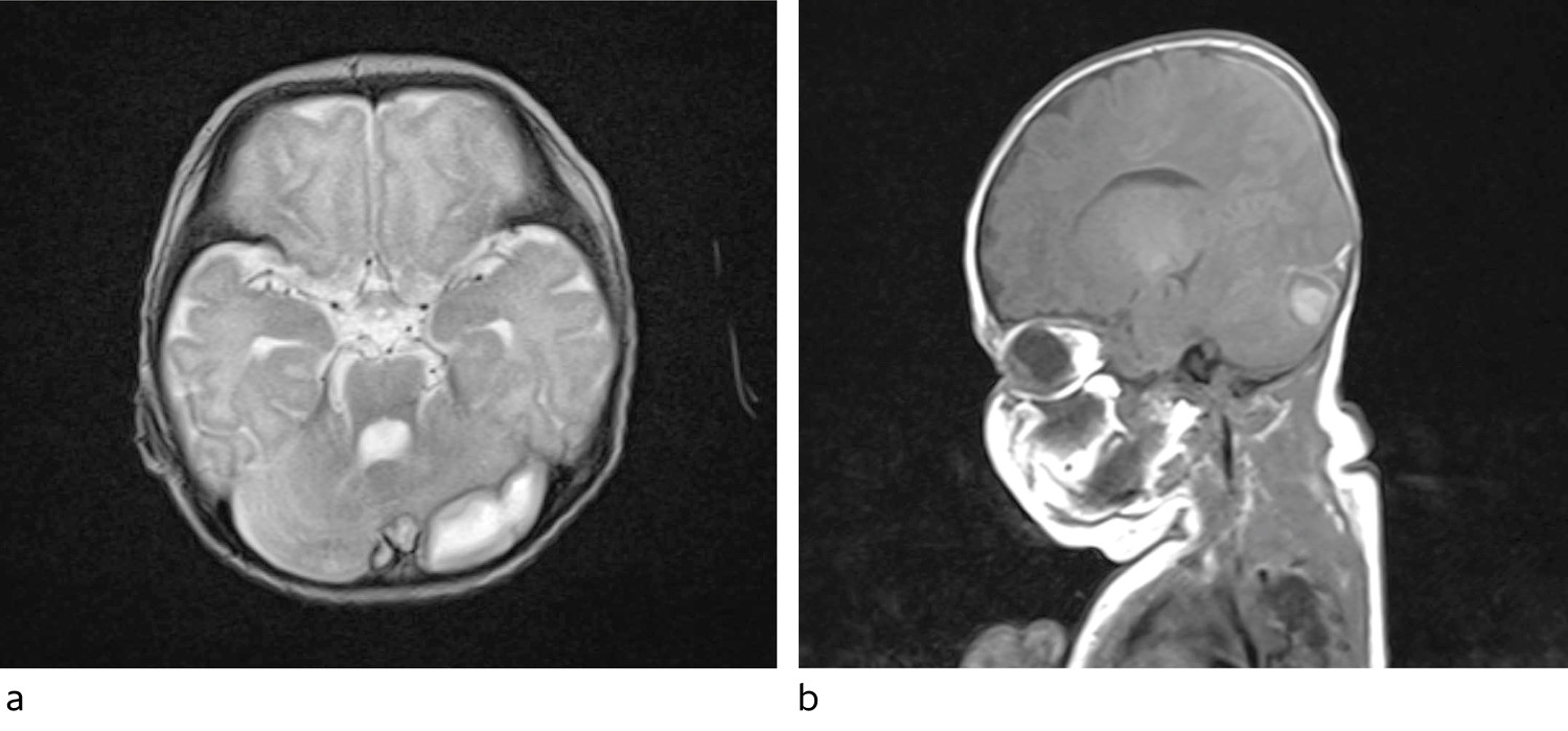 Figur 1 MR caput tatt &eacute;n uke inn i sykeforl&oslash;pet. Transversalsnitt (a) og sagittalsnitt (b) som begge viser den st&oslash;rste&hellip;