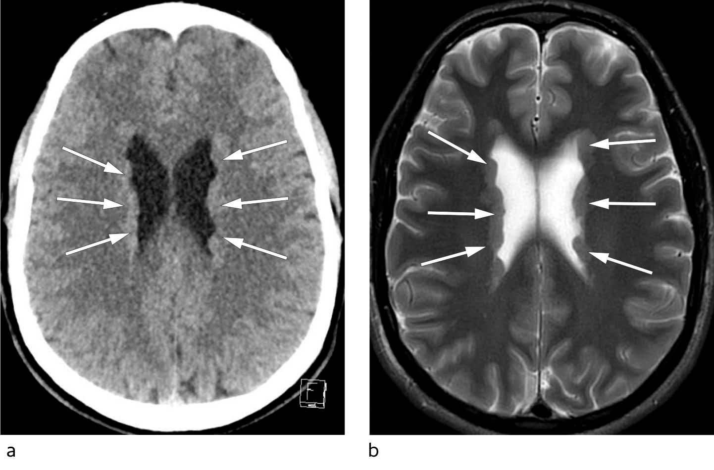 Figur 1 Nodul&aelig;re periventrikul&aelig;re forandringer som buker lett inn i ventriklene (piler). a) Cerebral CT uten kontrast,&hellip;