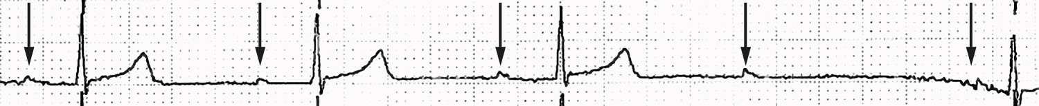 Figur 2 EKG viser atrioventrikul&aelig;r blokkering (AV-blokk). P-b&oslash;lger markert med piler. Etter fjerde p-b&oslash;lge er det bortfall&hellip;