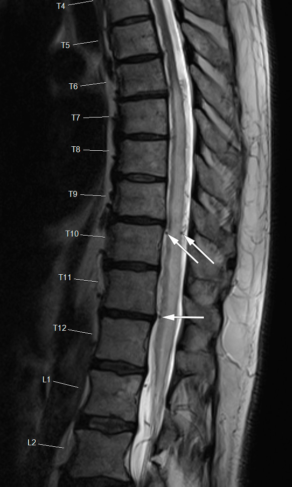 Figur 1 Sagittalt T2-vektet MR av Th-L-columna. Volum&oslash;kt, hyperintens medulla med sentralt &oslash;dem (Th6&ndash;L1). Signaltap (flow&hellip;