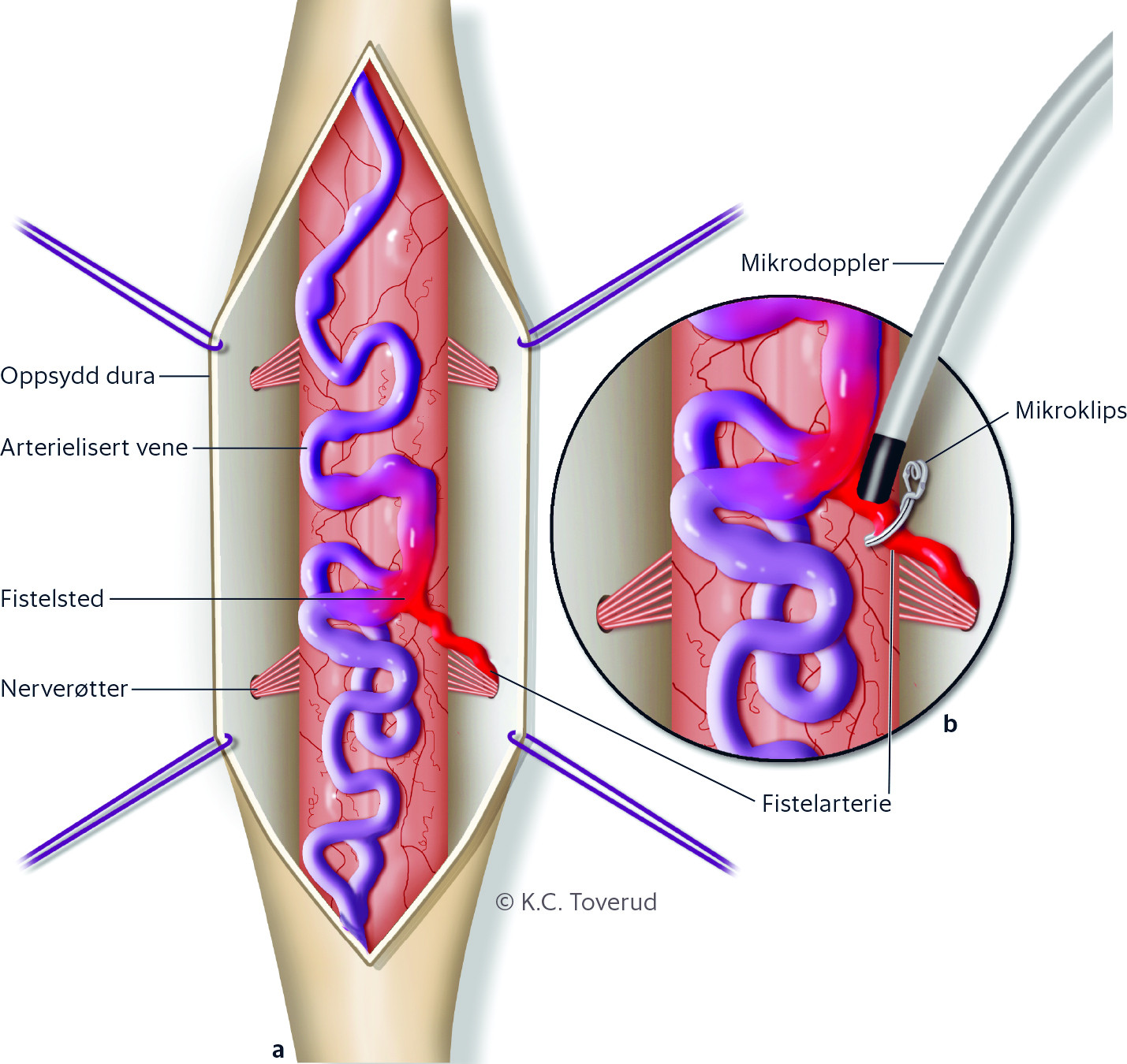 Figur 3 a) Illustrasjonen viser ryggmargen bakfra. Dura mater er &aring;pnet og hengslet med tr&aring;der til sidene. P&aring; ryggmargen sees&hellip;