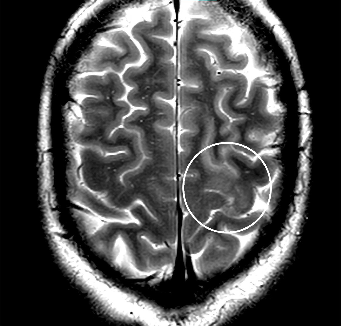 Figur 1 MR caput uten kontrast med beskjedent T2-h&oslash;ysignal kortikalt og subkortikalt i prim&aelig;rmotoriske cortex i venstre&hellip;