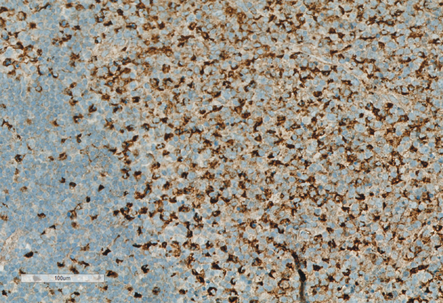 Figur 2 Detalj av CD68-immunfarging. Man ser tydelig et &oslash;kt antall histiocyt&aelig;re celler.