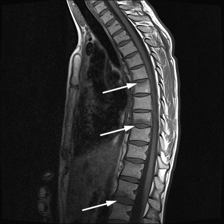 Figur 1 MR av torakalcolumna med sagittal T1-sekvens viser frakturer og benmargs&oslash;dem i &oslash;vre dekkplate i virvelcorpus T7 og&hellip;