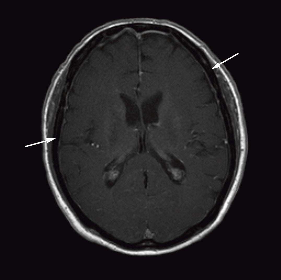 Figur 1 MR caput etter injeksjon av kontrastmiddel (aksialt snitt) viser fortykkede og kontrastladende meninger over begge&hellip;