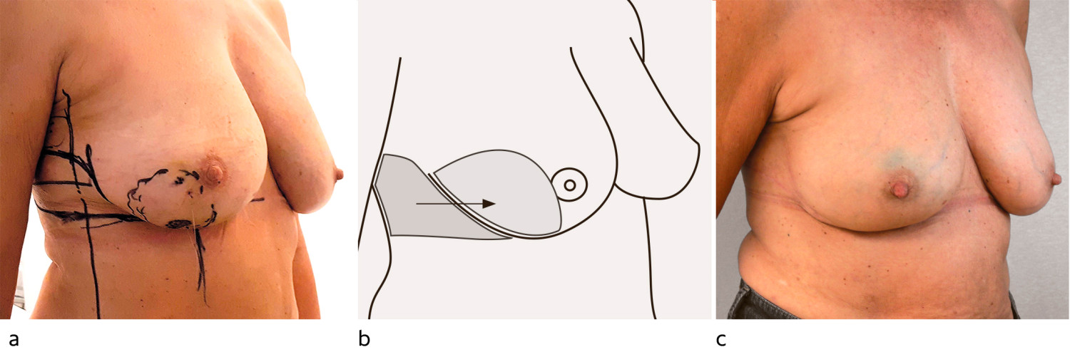 Figur 6 Erstatningsplastikk. Kun h&oslash;yre side er operert. a) Stor tumor i nedre laterale kvadrant av h&oslash;yre bryst (stiplet&hellip;
