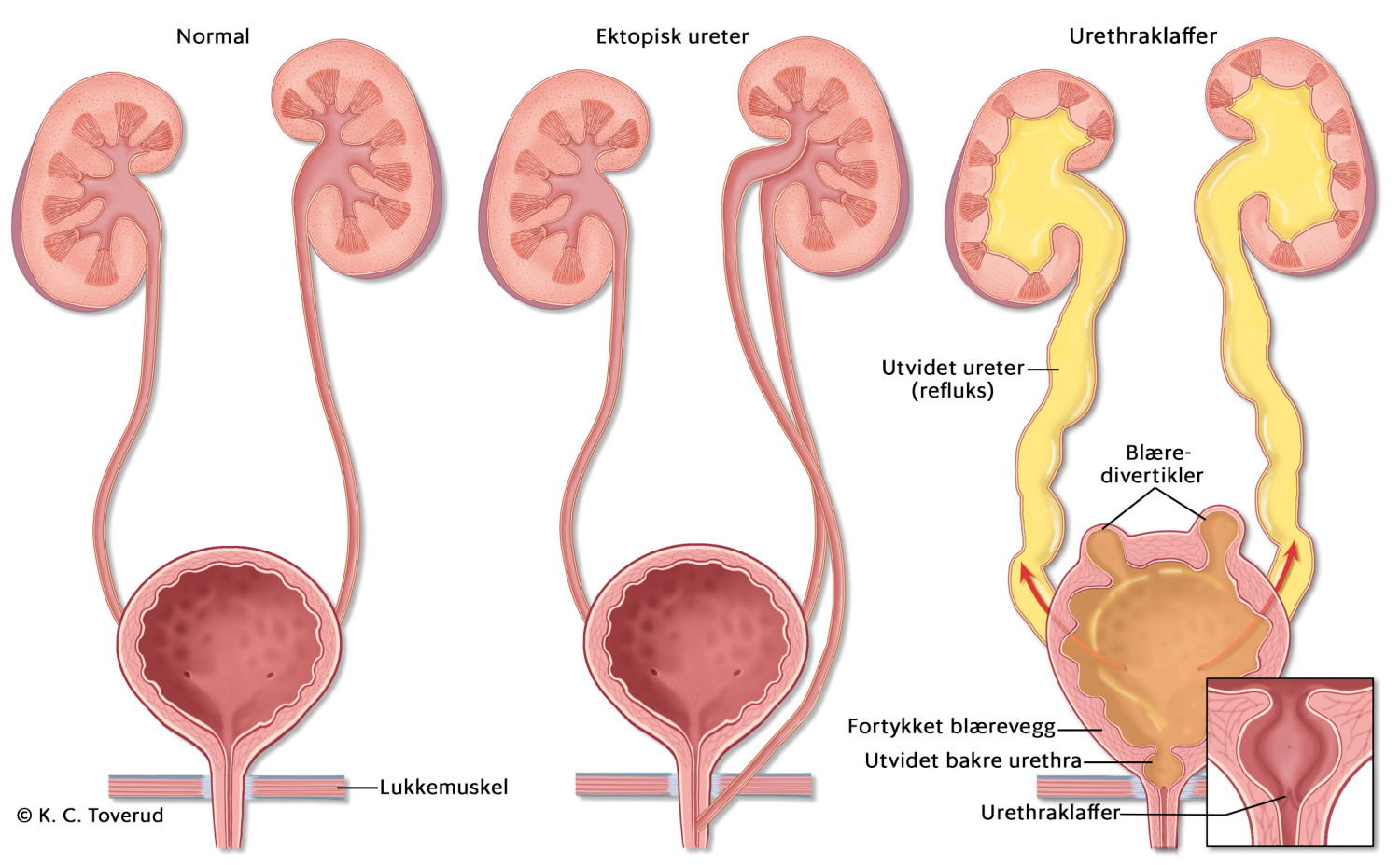 Figur 2 Til venstre illustreres normale anatomiske forhold, i midten venstresidig dobbelt nyreanlegg med ektopisk venstre&hellip;