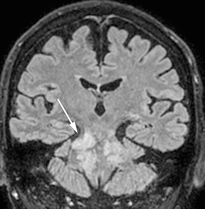 Figur 1 MR av hodet tatt en m&aring;ned etter f&oslash;rste utskrivelse. Koronal rekonstruksjon av 3D-T2-FLAIR viser&hellip;