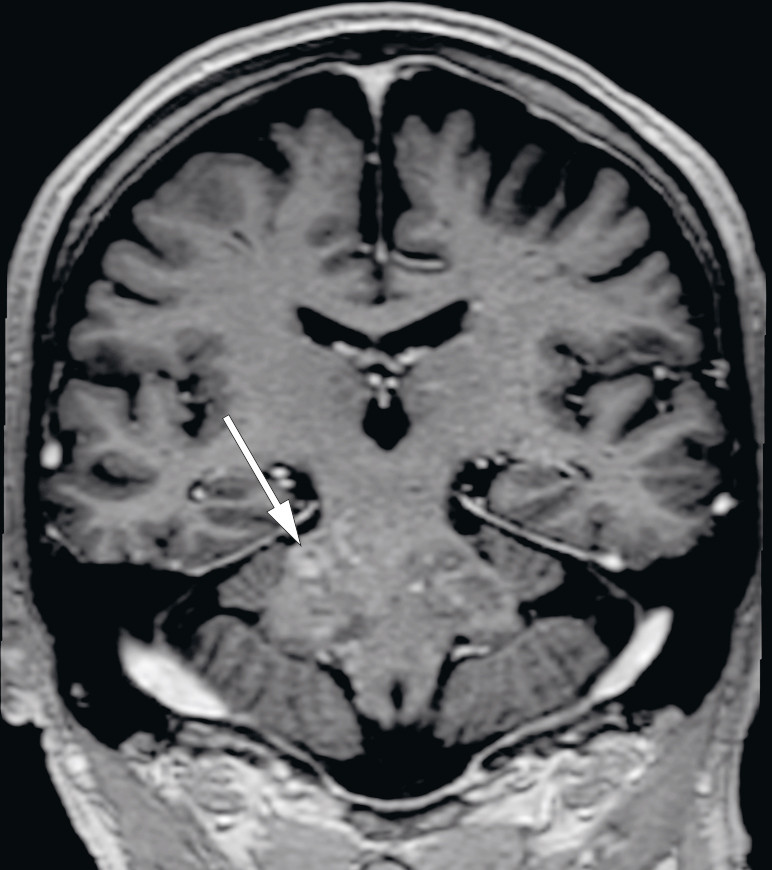 Figur 2 MR av hodet med kontrast tatt en m&aring;ned etter f&oslash;rste utskrivelse. Koronal rekonstruksjon av 3D-T1-vektet serie med&hellip;