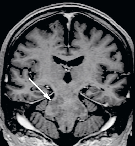Figur 3 MR av hodet tatt f&oslash;r siste utskrivelse. Koronal rekonstruksjon av 3D-T1-vektet serie med gadoliniumkontrastmiddel&hellip;