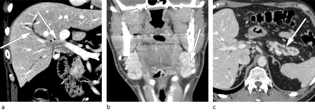 Figur 1 a) CT abdomen viser oppfylning i leverhilum med dilaterte intrahepatiske galleganger. b) CT collum viser bilateralt&hellip;