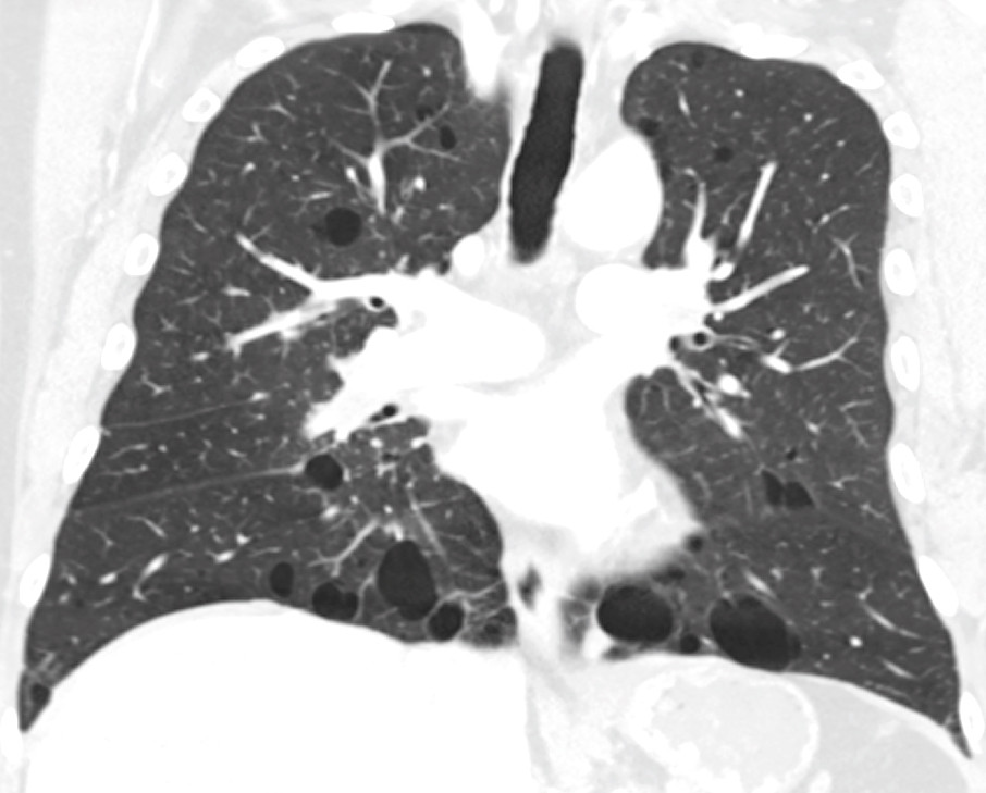 Figur 1 Birt-Hogg-Dub&eacute;-syndrom. CT thorax viser karakteristiske cyster. Cystene ligger hovedsakelig basalt, perivaskul&aelig;rt og&hellip;