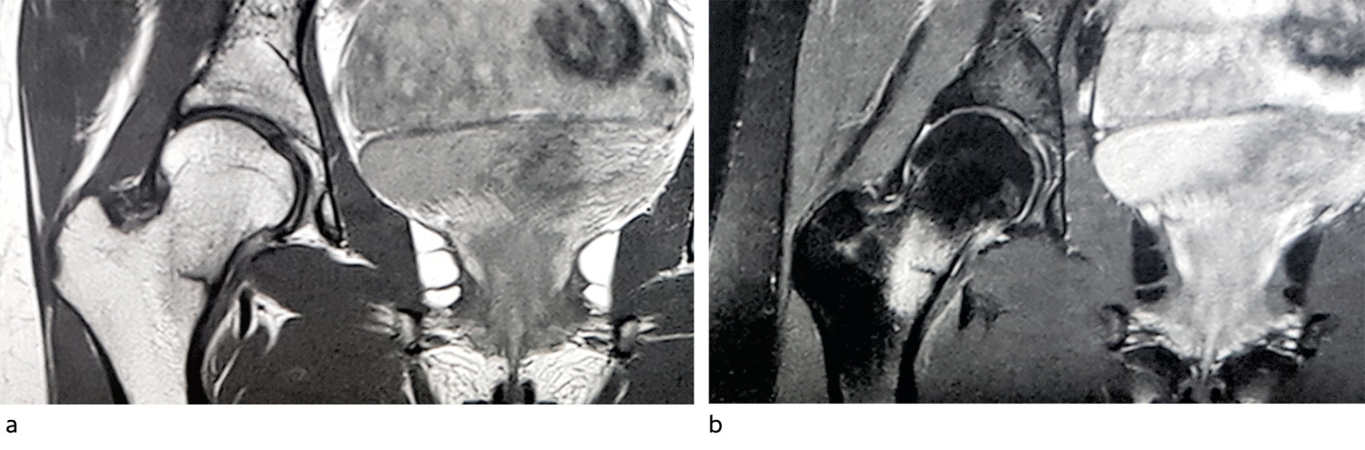 Figur 1 T1- (a) og T2-vektet (b) MR av bekkenet viser inferomedial stressfraktur i l&aring;rhalsen, grad 4b.