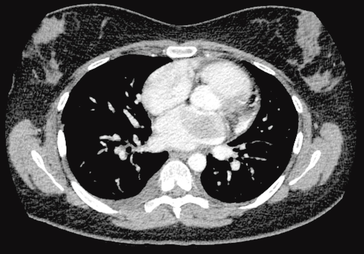 Figur 2 Aksialt CT-bilde med intraven&oslash;s kontrast viste en 4,5 &times; 2,5 cm lavattenuerende oppfylning i venstre atrium som rager&hellip;