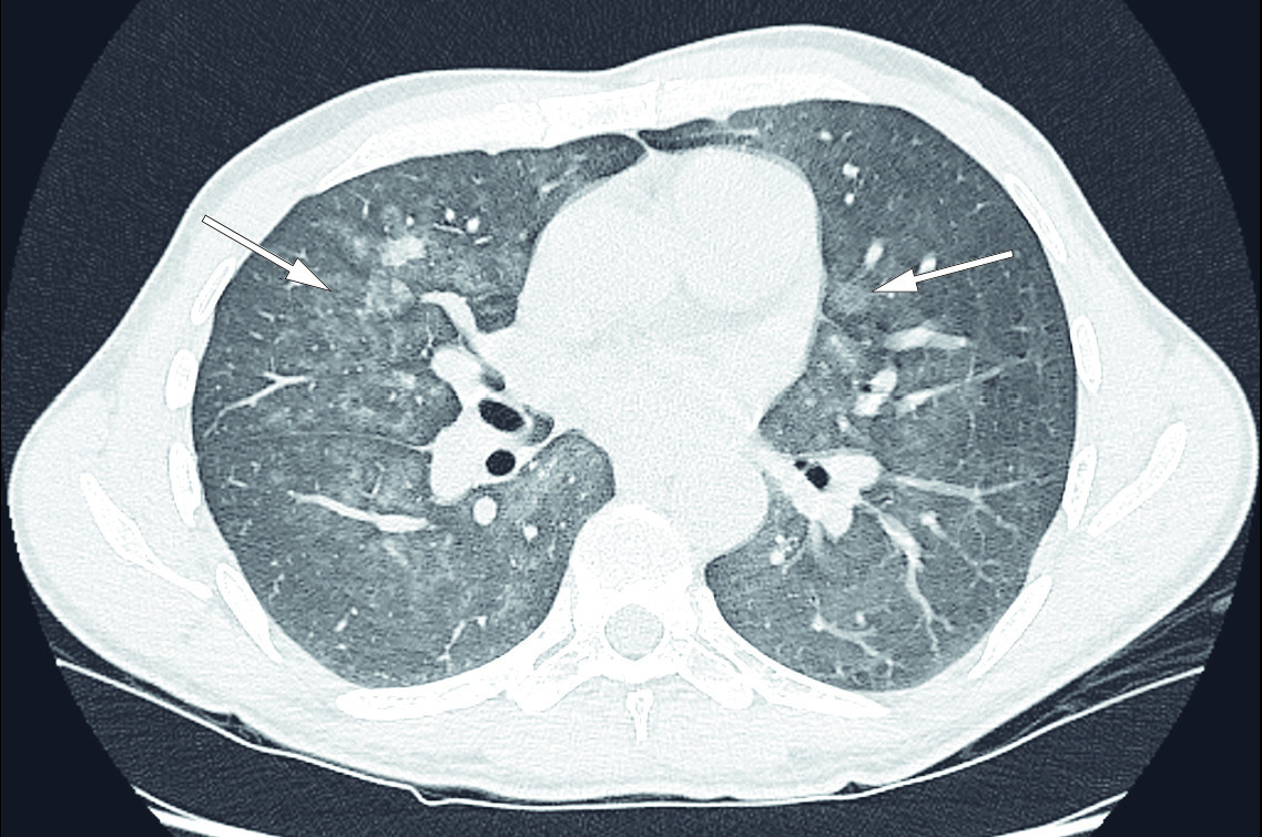 Figure 2 CT of the lungs with patchy, bilateral ground glass opacities (arrows).