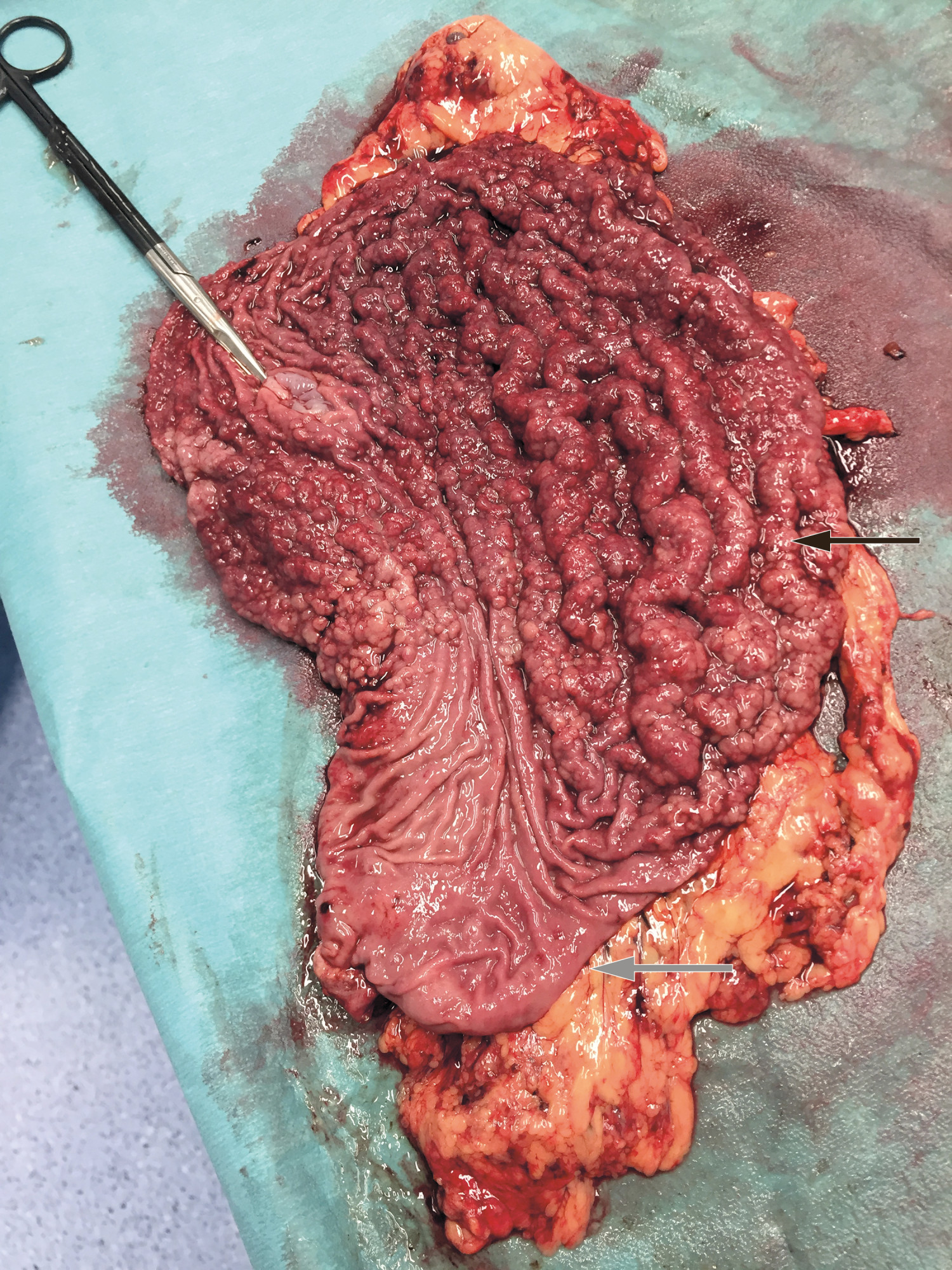 Figur 1 Oppklippet magesekk med normal slimhinne i antrum (gr&aring; pil) og multiple sm&aring; polypper i korpus- og fundusdelene av&hellip;