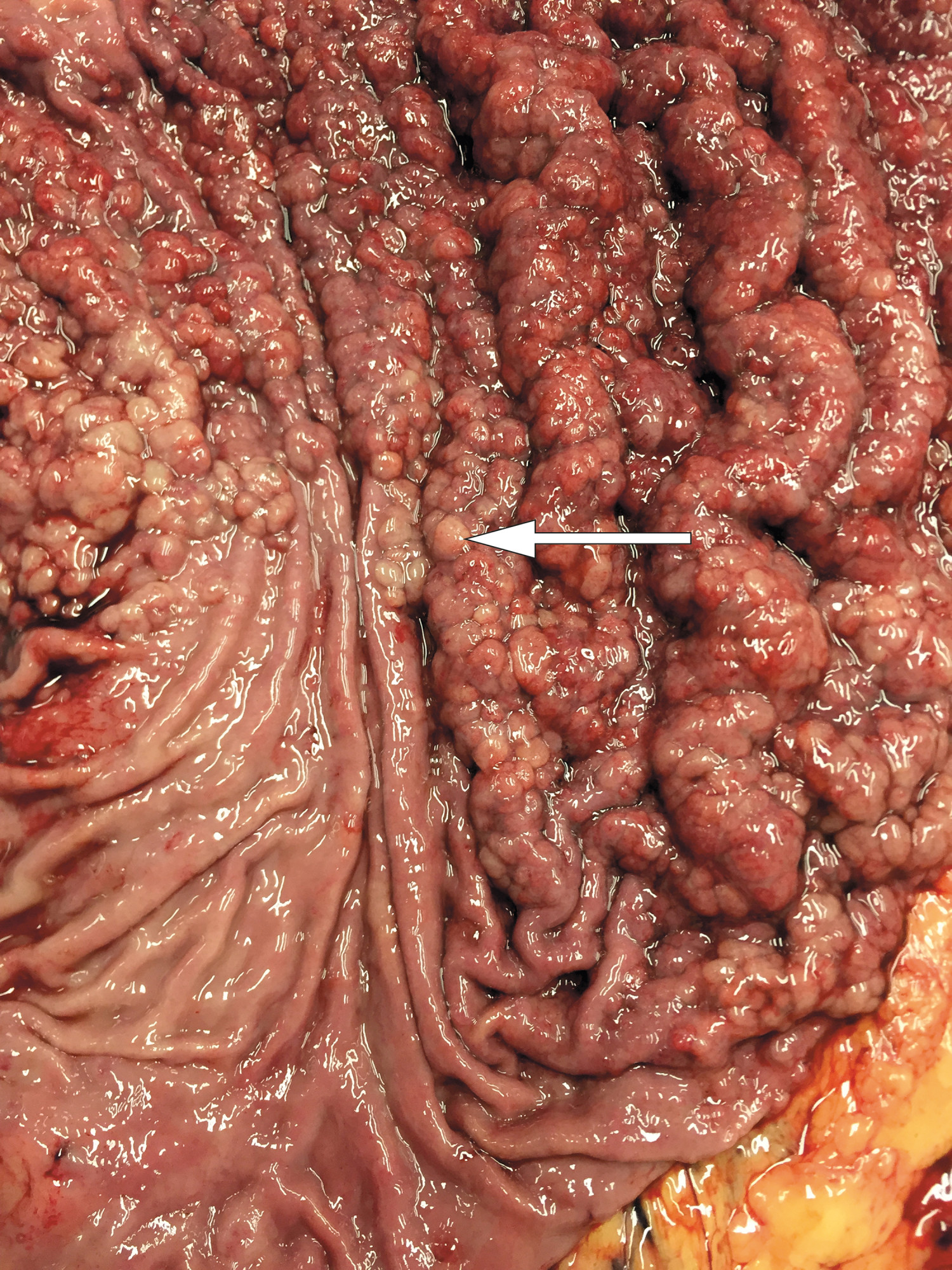 Figur 2 N&aelig;rbilde av overgangen mellom affisert og normal slimhinne. Bildet viser de multiple sm&aring; polyppene (pil) i&hellip;
