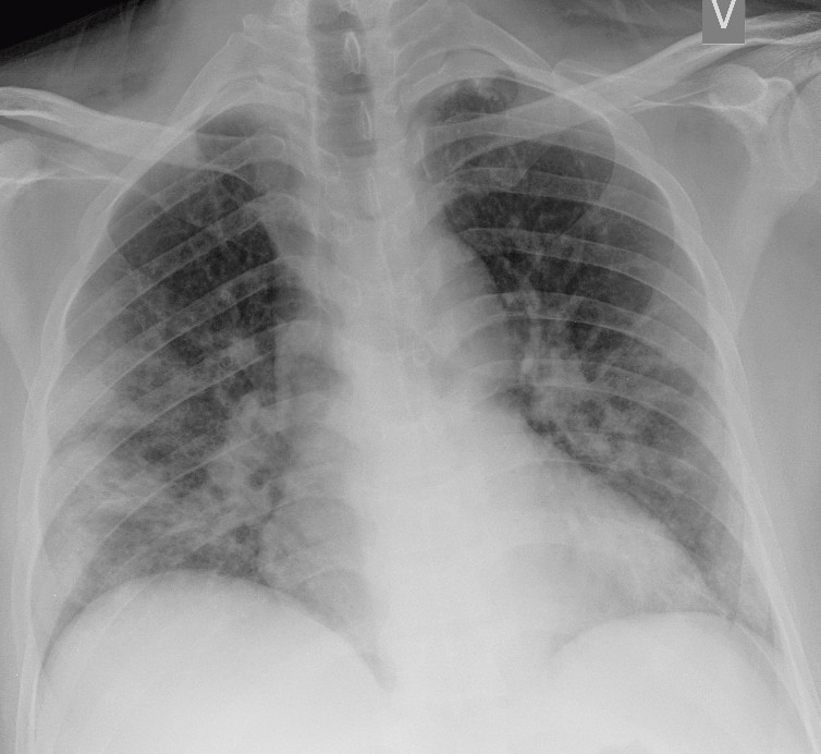 Figur 1 Pasient med covid-19 innlagt med redusert allmenntilstand, t&oslash;rrhoste og &oslash;kende dyspn&eacute;. R&oslash;ntgen thorax tatt liggende&hellip;
