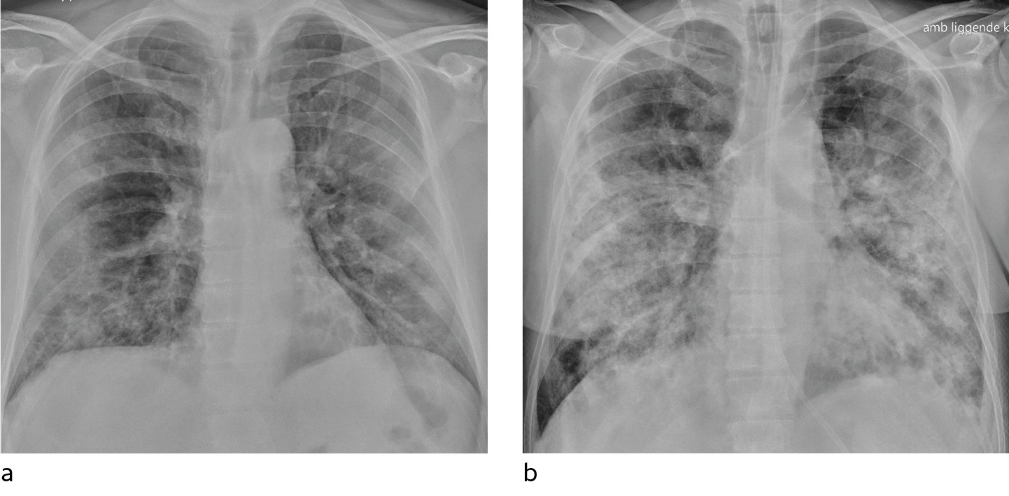 Figure 3 a) Patient with COVID-19. Bedside chest X-ray 10 days after symptom onset shows predominantly patchy opacities&hellip;