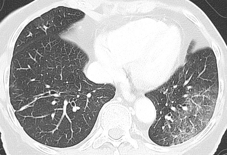 Figur 4 Pasient med covid-19 med nedsatt allmenntilstand, kvalme, oppkast, synkope og mulige frostrier. CT thorax to dager&hellip;